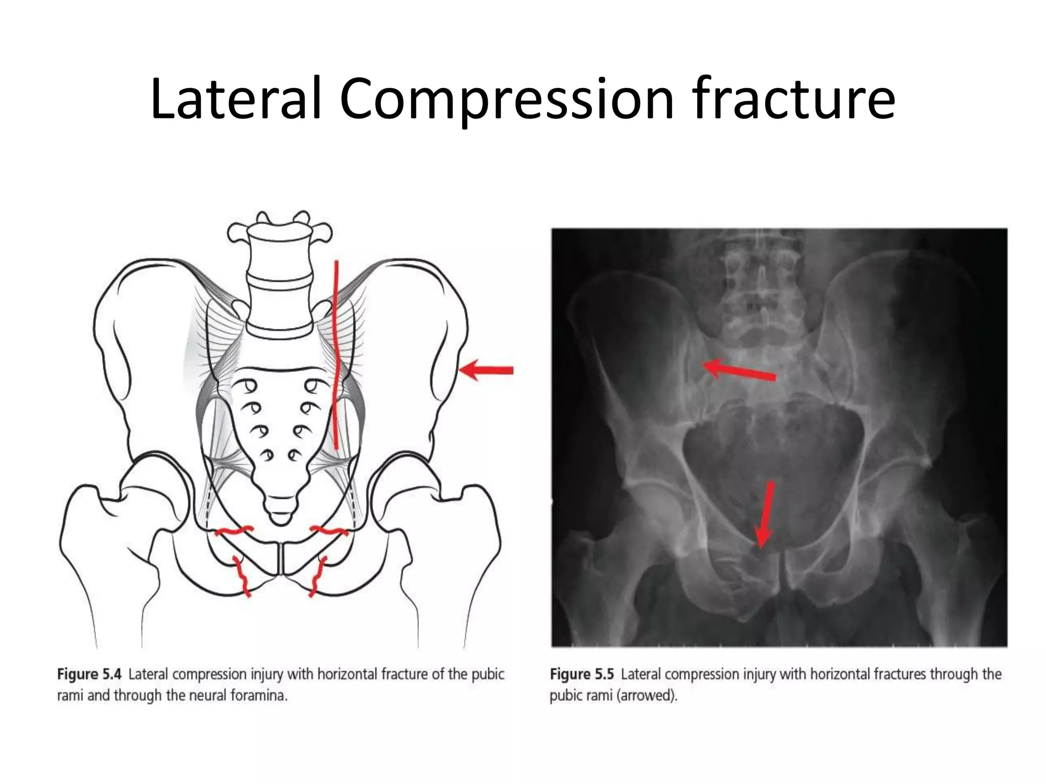 Lateral Compression Text Radiological evaluation of Lower Limb in acute ED setting !! | PPTX