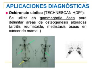 ■   Oxidronato sódico  (TECHNESCAN HDP ® ): Se utiliza en  gammagrafía ósea  para delimitar áreas de osteogénesis alteradas (artritis reumatoide, metástasis óseas en cáncer de mama..) APLICACIONES DIAGNÓSTICAS 