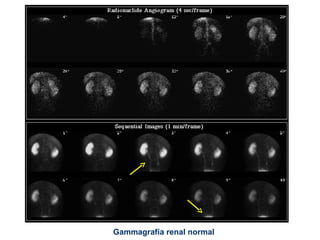 Gammagrafía renal normal 
