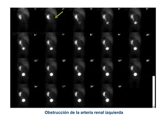 Obstrucción de la arteria renal izquierda 