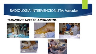 RADIOLOGÍA INTERVENCIONISTA: Vascular
TRATAMIENTO LASER DE LA VENA SAFENA
 