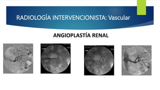 RADIOLOGÍA INTERVENCIONISTA: Vascular
ANGIOPLASTÍA RENAL
 