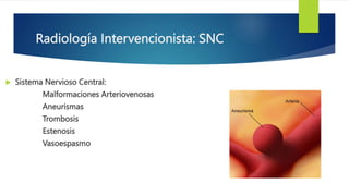 Radiología Intervencionista: SNC
 Sistema Nervioso Central:
Malformaciones Arteriovenosas
Aneurismas
Trombosis
Estenosis
...