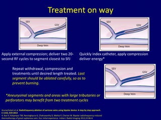 Perforator Rfa Radiofrequency ablation of varicose veins Dr. Muhammad Bin Zulfiqar | PPTX