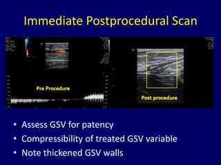 Radiofrequency ablation of varicose veins Dr. Muhammad Bin Zulfiqar | PPTX