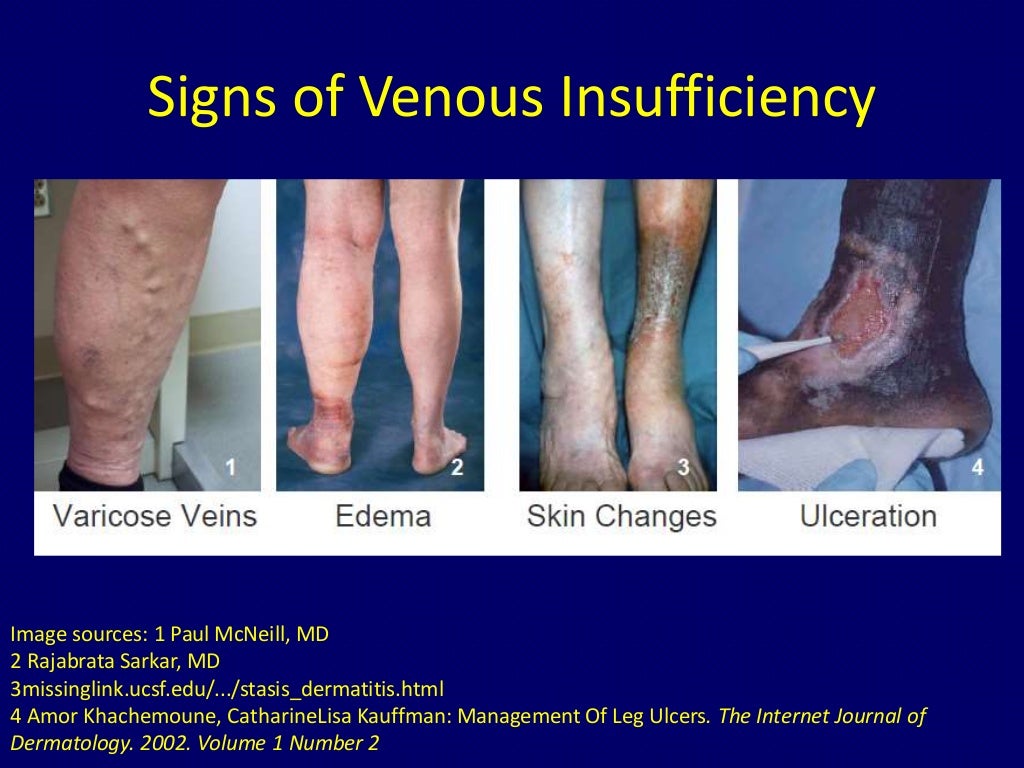 Radiofrequency ablation of varicose veins Dr. Muhammad Bin Zulfiqar