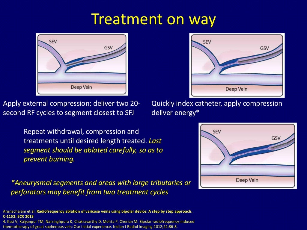 Radiofrequency ablation of varicose veins Dr. Muhammad Bin Zulfiqar
