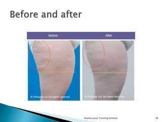 Avante Laser Training Institute 38
 