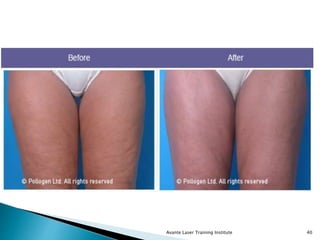 Avante Laser Training Institute 40
 