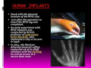 HUMAN IMPLANTS 
 Hand with the planned 
location of the RFID chip 
 Just after the operation to 
insert the RFID tag was 
completed. 
 An early experiment with 
RFID implants was 
conducted by British 
professor of cybernetics 
Kevin Warwick, who 
implanted a chip in his arm 
in 1998. 
 In 2004, the Mexican 
Attorney General's office 
implanted 18 of its staff 
members with the Verichip 
to control access to a 
secure data room . 
 