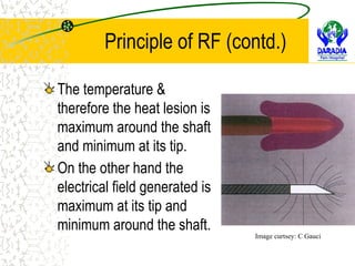 Radio Frequency Techniques in Pain Management | RFA, Pulsed RF, Cooled ...