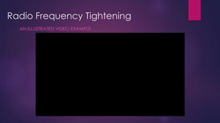 Radio Frequency Tightening
AN ILLUSTRATED VIDEO EXAMPLE
 