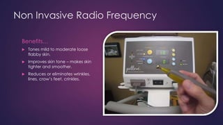 Non Invasive Radio Frequency
Benefits…
 Tones mild to moderate loose
flabby skin.
 Improves skin tone – makes skin
tighter and smoother.
 Reduces or eliminates wrinkles,
lines, crow’s feet, crinkles.
 