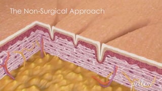 The Non-Surgical Approach
 