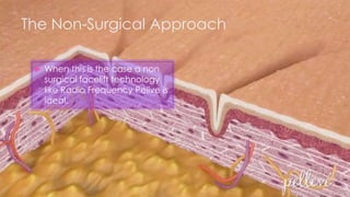 The Non-Surgical Approach
 When this is the case a non
surgical facelift technology
like Radio Frequency Pellve is
ideal.
 