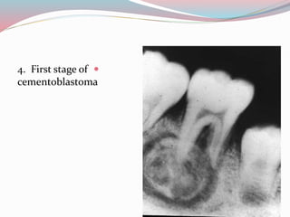 Dental common disease on x-ray | by Dr.mohammad nameer | PPTX