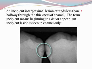 An incipient interpraximal lesion extends less than
halfway through the thickness of enamel, The term
incipient means beginning to exist or appear. An
incipient lesion is seen in enamel only.
 