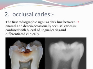2. occlusal caries:-
The first radiographic sign is a dark line between
enamel and dentin occasionally occlusal caries is
confused with buccal of lingual caries and
differentiated clinically.

 