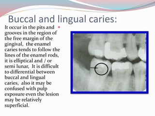 Buccal and lingual caries:
It occur in the pits and
grooves in the region of
the free margin of the
gingival, the enamel
caries tends to follow the
lines of the enamel rods,
it is elliptical and / or
semi lunar, It is difficult
to differential between
buccal and lingual
caries, also it may be
confused with pulp
exposure even the lesion
may be relatively
superficial.
 