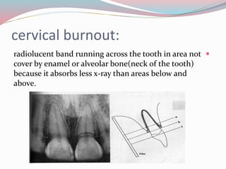 cervical burnout:
radiolucent band running across the tooth in area not
cover by enamel or alveolar bone(neck of the tooth)
because it absorbs less x-ray than areas below and
above.
 