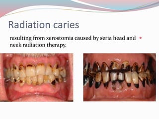 Radiation caries
resulting from xerostomia caused by seria head and
neek radiation therapy.
 