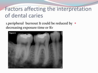 Factors affecting the interpretation
of dental caries
1.peripheral burnout It could be reduced by
decreasing exposure time or Kv
 