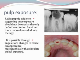 pulp exposure:
Radiographic evidence
suggesting pulp exposure
should not be used as the only
definitive criterion for either
tooth removal or endodontic
therapy.
It is possible through
angulations changes to create
on appearance
radiographically that simulate
pulpal exposure.
 