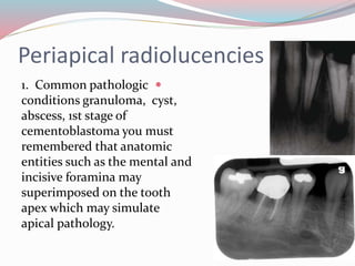 Periapical radiolucencies
1. Common pathologic
conditions granuloma, cyst,
abscess, 1st stage of
cementoblastoma you must
remembered that anatomic
entities such as the mental and
incisive foramina may
superimposed on the tooth
apex which may simulate
apical pathology.
 