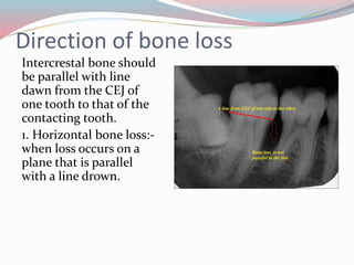 Direction of bone loss
Intercrestal bone should
be parallel with line
dawn from the CEJ of
one tooth to that of the
contacting tooth.
1. Horizontal bone loss:-
when loss occurs on a
plane that is parallel
with a line drown.
 