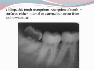 2.Idiopathic tooth resorption: resorption of tooth
surfaces, either internal or external can occur from
unknown cause
 