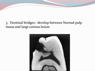 3. Dentinal bridges:- develop between Normal pulp
tissue and large carious lesion
 