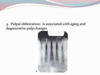 4. Pulpal obliteration: is associated with aging and
degenerative pulp changes
 