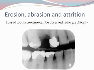 Erosion, abrasion and attrition
Loss of tooth structure can be observed radio graphically
 