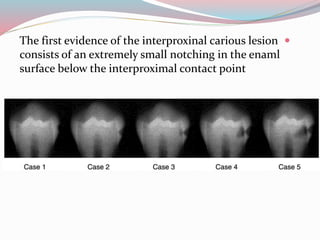 The first evidence of the interproxinal carious lesion
consists of an extremely small notching in the enaml
surface below the interproximal contact point
 