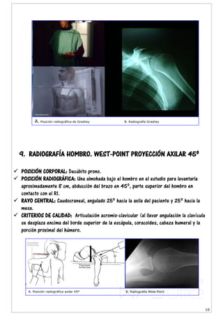 10
9. RADIOGRAFÍA HOMBRO. WEST-POINT PROYECCIÓN AXILAR 45º
 POSICIÓN CORPORAL: Decúbito prono.
 POSICIÓN RADIOGRÁFICA: Una almohada bajo el hombro en el estudio para levantarla
aproximadamente 8 cm, abducción del brazo en 45º, parte superior del hombro en
contacto con el RI.
 RAYO CENTRAL: Caudocraneal, angulado 25º hacia la axila del paciente y 25º hacia la
mesa.
 CRITERIOS DE CALIDAD: Articulación acromio-clavicular (al llevar angulación la clavícula
se desplaza encima del borde superior de la escápula, coracoides, cabeza humeral y la
porción proximal del húmero.
A. Posición radiográfica de Grashey B. Radiografía Grashey
A. Posición radiográfica axilar 45º B. Radiografía West-Point
 