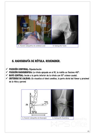 15
5. RADIOGRAFÍA DE RÓTULA. ROSENGBER.
 POSICIÓN CORPORAL: Bipedestación
 POSICIÓN RADIOGRÁFICA: La rótula apoyada en el RI, la rodilla se flexiona 45º.
 RAYO CENTRAL: Incide a la parte inferior de la rótula con 10º cráneo-caudal.
 CRITERIOS DE CALIDAD: Se visualiza el túnel condileo, la parte distal del fémur y proximal
de la tibia y peroné
A. Posición radiográfica de acetábulo axial B. Radiografía Teufel.
A. Posición radiográfica de Rosengber B. Radiografía Rosenberg
 