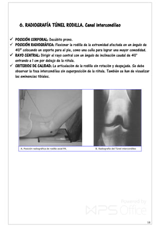 16
6. RADIOGRAFÍA TÚNEL RODILLA. Canal intercondíleo
 POSICIÓN CORPORAL: Decúbito prono.
 POSICIÓN RADIOGRÁFICA: Flexionar la rodilla de la extremidad afectada en un ángulo de
40º colocando un soporte para el pie, como una cuña para lograr una mayor comodidad.
 RAYO CENTRAL: Dirigir el rayo central con un ángulo de inclinación caudal de 40°
entrando a 1 cm por debajo de la rótula.
 CRITERIOS DE CALIDAD: La articulación de la rodilla sin rotación y despejada. Se debe
observar la fosa intercondílea sin superposición de la rótula. También se han de visualizar
las eminencias tibiales.
A. Posición radiográfica de rodilla axial PA. B. Radiografía del Túnel intercondíleo
 
