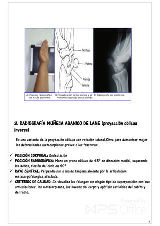 4
3. RADIOGRAFÍA MUÑECA ABANICO DE LANE (proyección oblicua
inversa)
Es una variante de la proyección oblicua con rotación lateral.Sirve para demostrar mejor
las deformidades metacarpianas graves o las fracturas.
 POSICIÓN CORPORAL: Sedestación
 POSICIÓN RADIOGRÁFICA: Mano en prono oblicuo de 45º en dirección medial, separando
los dedos, flexión del codo en 90º
 RAYO CENTRAL: Perpendicular e incide tangencialmente por la articulación
metacarpofalángica afectada.
 CRITERIOS DE CALIDAD: Se visualiza las falanges sin ningún tipo de superposición con sus
articulaciones, los metacarpianos, los huesos del carpo y apófisis estiloides del cubito y
del radio.
A. Posición radiográfica B. Visualización de los carpos y el C. Radiografía del pisiforme.
en RX de pisiforme. Pisiforme separado de los demás.
 