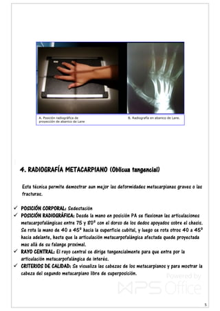 5
4. RADIOGRAFÍA METACARPIANO (Oblicua tangencial)
Esta técnica permite demostrar aun mejor las deformidades metacarpianas graves o las
fracturas.
 POSICIÓN CORPORAL: Sedestación
 POSICIÓN RADIOGRÁFICA: Desde la mano en posición PA se flexionan las articulaciones
metacarpofalángicas entre 75 y 80º con el dorso de los dedos apoyados sobre el chasis.
Se rota la mano de 40 a 45º hacia la superficie cubital, y luego se rota otros 40 a 45º
hacia adelante, hasta que la articulación metacarpofalángica afectada quede proyectada
mas allá de su falange proximal.
 RAYO CENTRAL: El rayo central se dirige tangencialmente para que entre por la
articulación metacarpofalángica de interés.
 CRITERIOS DE CALIDAD: Se visualiza las cabezas de los metacarpianos y para mostrar la
cabeza del segundo metacarpiano libre de superposición.
A. Posición radiográfica de B. Radiografía en abanico de Lane.
proyección de abanico de Lane
 