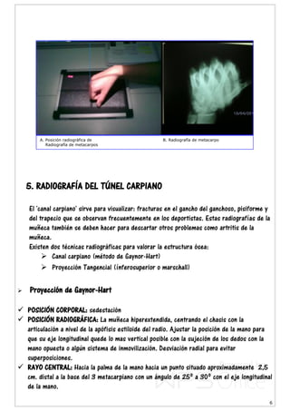 6
5. RADIOGRAFÍA DEL TÚNEL CARPIANO
El 'canal carpiano' sirve para visualizar: fracturas en el gancho del ganchoso, pisiforme y
del trapecio que se observan frecuentemente en los deportistas. Estas radiografías de la
muñeca también se deben hacer para descartar otros problemas como artritis de la
muñeca.
Existen dos técnicas radiográficas para valorar la estructura ósea:
 Canal carpiano (método de Gaynor-Hart)
 Proyección Tangencial (ínferosuperior o marschall)
 Proyección de Gaynor-Hart
 POSICIÓN CORPORAL: sedestación
 POSICIÓN RADIOGRÁFICA: La muñeca hiperextendida, centrando el chasis con la
articulación a nivel de la apófisis estiloide del radio. Ajustar la posición de la mano para
que su eje longitudinal quede lo mas vertical posible con la sujeción de los dedos con la
mano opuesta o algún sistema de inmovilización. Desviación radial para evitar
superposiciones.
 RAYO CENTRAL: Hacia la palma de la mano hacia un punto situado aproximadamente 2,5
cm. distal a la base del 3 metacarpiano con un ángulo de 25º a 30º con el eje longitudinal
de la mano.
A. Posición radiográfica de B. Radiografía de metacarpo
Radiografía de metacarpos
 