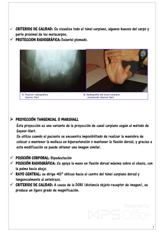 7
 CRITERIOS DE CALIDAD: Se visualiza todo el túnel carpiano, algunos huesos del carpo y
parte proximal de los metacarpos.
 PROTECCION RADIOGRÁFICA: Delantal plomado.
 PROYECCIÓN TANGENCIAL O MARSHALL
Ésta proyección es una variante de la proyección de canal carpiano según el método de
Gaynor-Hart.
Se utiliza cuando el paciente se encuentra imposibilitado de realizar la maniobra de
colocar o mantener la muñeca en hiperextensión o mantener la flexión dorsal, y gracias a
esta modificación se puede obtener una imagen similar.
 POSICIÓN CORPORAL: Bipedestación
 POSICIÓN RADIOGRÁFICA: Se apoya la mano en flexión dorsal máxima sobre el chasis, con
la palma hacia abajo.
 RAYO CENTRAL: se dirige 45º oblicuo hacia el centro del túnel carpiano dorsal y
tangencialmente al antebrazo.
 CRITERIOS DE CALIDAD: A causa de la DORI (distancia objeto-receptor de imagen), se
produce un ligero grado de magnificación.
A. Posición radiográfica B. Radiografía del túnel carpiano
Gaynor Hart proyección Gaynor Hart
 