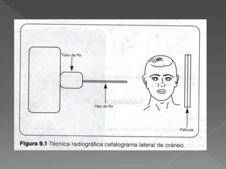 PROCEDIMIENTO1.- El paciente puede estar sentado o de pie2.-colocar al paciente en el cefalostato de manera q impedirá su movimiento.3.-el cefalograma  lateral y  postero anterior  (P-A), el tubo de rayos X debe de estar a 1.50 mts del receptor de imagen  y el rayo dirigido perpendicularmente a este, unos 2 cm por delante del trago.