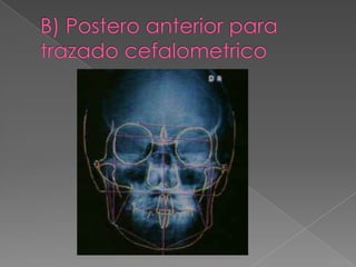 B) Postero anterior para trazado cefalometrico 