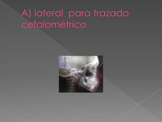 A) lateral  para trazado cefalométrico<br />
