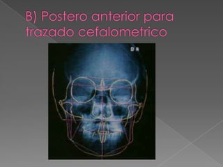 B) Postero anterior para trazado cefalometrico <br />