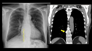RADIOGRAFÍA DE TORAX IMAGEN DYT new.pptx