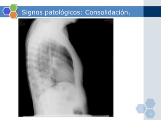 Signos patológicos: Consolidación . 