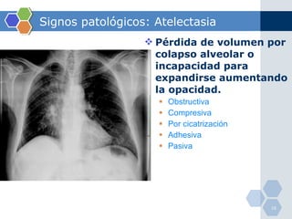 Signos patológicos: Atelectasia Pérdida de volumen por colapso alveolar o incapacidad para expandirse aumentando la opacidad. Obstructiva Compresiva Por cicatrización Adhesiva Pasiva 
