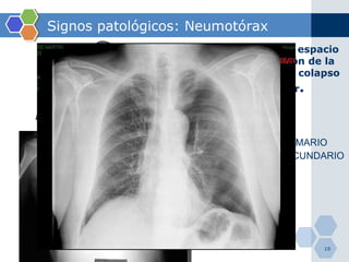 Signos patológicos: Neumotórax Entrada de aire en espacio pleural, disminución de la presión negativa y colapso pulmonar posterior . ESPONTÁNEO PRIMARIO ESPONTÁNEO SECUNDARIO TRAUMÁTICO YATROGÉNICO CATAMENIAL 