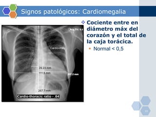 Signos patológicos: Cardiomegalia Cociente entre en diámetro máx del corazón y el total de la caja torácica. Normal < 0,5 